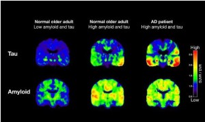 Study: Alzheimer’s Diagnosis Possible Years Before Onset of Symptoms With Scan