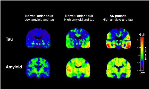 New Study Says Alzheimer's Diagnosis Possible Years Before Signs of Disease