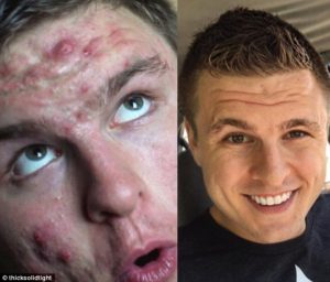 How To Beat Acne With A Vegan Diet: One Bodybuilder’s Story Of Overcoming Terrible Cystic Acne