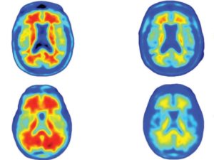 Amazing New Breakthrough In Alzheimer’s Study: Antibody Erases All Signs Of The Disease In The Brain