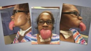 Handful Of Black COVID Survivors Experience Massively Enlarged Tongues