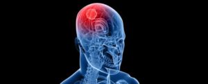 Stanford study finds inflammation in brains of deceased COVID-19 patients