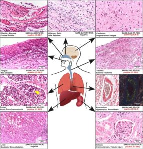 “Global Time Bomb”:  First case of postmortem study of patient vaccinated against SARS-CoV-2; “viral RNA found in every organ of the body”