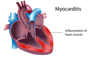 Estimated 1 in 95 boys diagnosed with myocarditis in a California private school