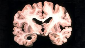 COVID Brain Changes Show Parallels With Alzheimer’s Disease