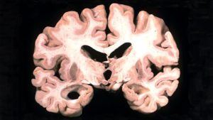 COVID Brain Changes Show Parallels With Alzheimer’s Disease