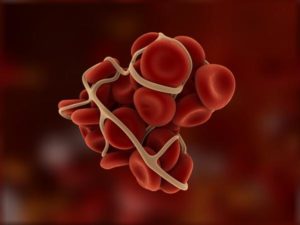 Post–COVID Vaccine AHA Cases Raise Eyebrows in Italy