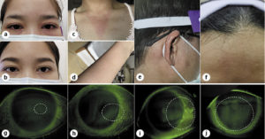 Ocular Surface Erosion after Suspected Exposure to Evaporated COVID-19 Vaccine